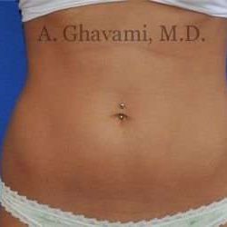 Liposuction Before & After Patient #7432