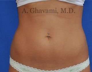 Liposuction Before & After Patient #7432