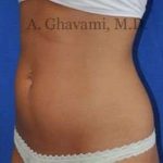 Liposuction Before & After Patient #7432