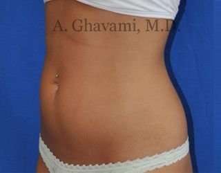 Liposuction Before & After Patient #7432