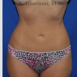 Liposuction Before & After Patient #7427