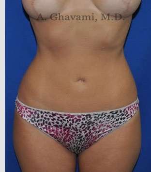Liposuction Before & After Patient #7427