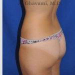 Liposuction Before & After Patient #7427
