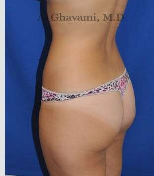 Liposuction Before & After Patient #7427
