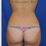 Liposuction Before & After Patient #7427