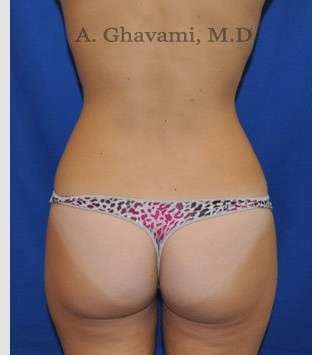 Liposuction Before & After Patient #7427