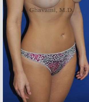 Liposuction Before & After Patient #7427