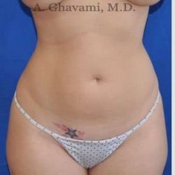 Liposuction Before & After Patient #7427