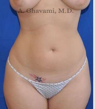 Liposuction Before & After Patient #7427
