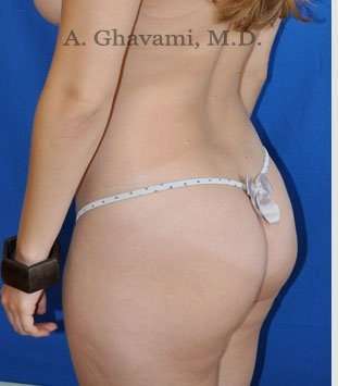Liposuction Before & After Patient #7427
