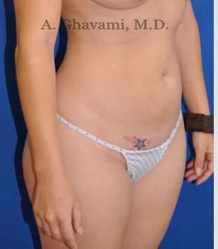 Liposuction Before & After Patient #7427