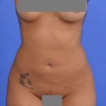 Liposuction Before & After Patient #7418
