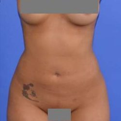 Liposuction Before & After Patient #7418