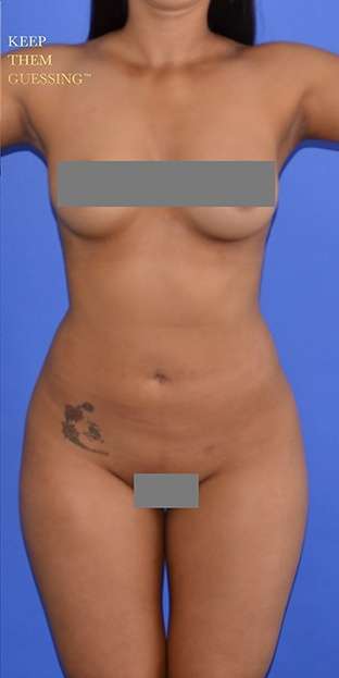 Liposuction Before & After Patient #7418