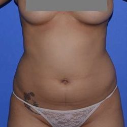 Liposuction Before & After Patient #7418