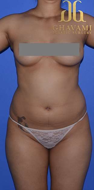 Liposuction Before & After Patient #7418