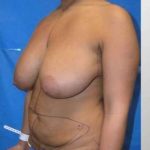 Mommy Makeover Before & After Patient #7415