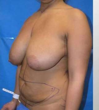 Mommy Makeover Before & After Patient #7415