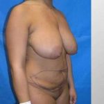 Mommy Makeover Before & After Patient #7415