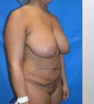 Mommy Makeover Before & After Patient #7415