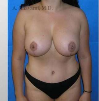 Mommy Makeover Before & After Patient #7410
