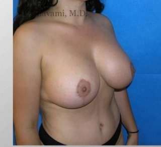 Mommy Makeover Before & After Patient #7410