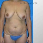Mommy Makeover Before & After Patient #7410