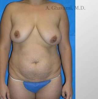 Mommy Makeover Before & After Patient #7410
