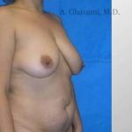 Mommy Makeover Before & After Patient #7410