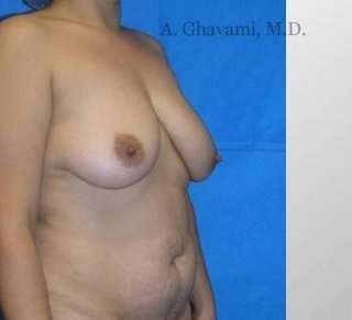 Mommy Makeover Before & After Patient #7410