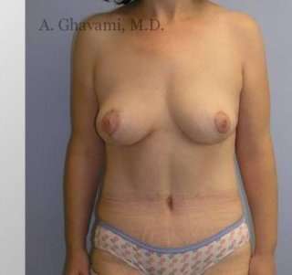 Mommy Makeover Before & After Patient #7405