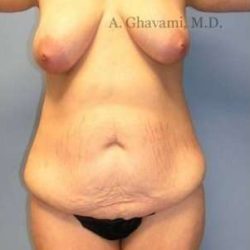 Mommy Makeover Before & After Patient #7405