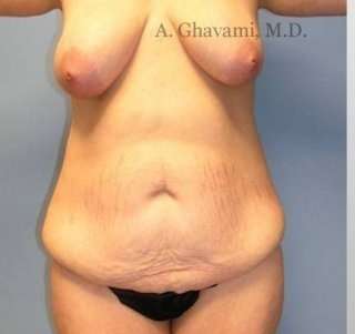 Mommy Makeover Before & After Patient #7405