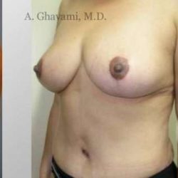 Mommy Makeover Before & After Patient #7402