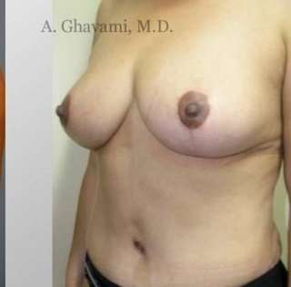 Mommy Makeover Before & After Patient #7402