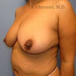 Mommy Makeover Before & After Patient #7402