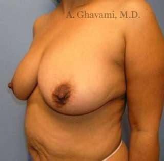 Mommy Makeover Before & After Patient #7402