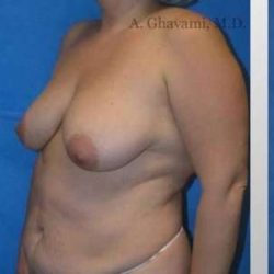 Mommy Makeover Before & After Patient #7399