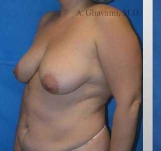 Mommy Makeover Before & After Patient #7399