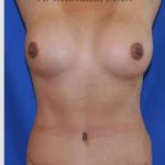 Mommy Makeover Before & After Patient #7396
