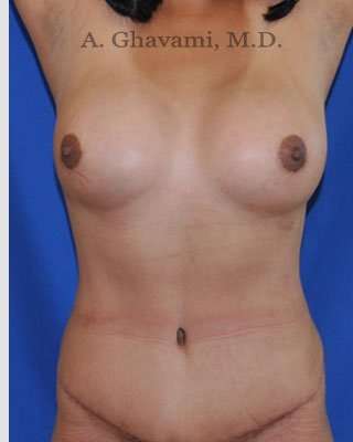 Mommy Makeover Before & After Patient #7396