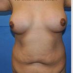 Mommy Makeover Before & After Patient #7396