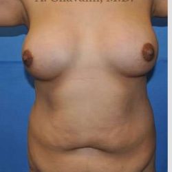 Mommy Makeover Before & After Patient #7396