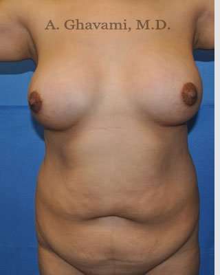 Mommy Makeover Before & After Patient #7396
