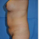 Mommy Makeover Before & After Patient #7396