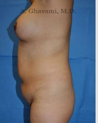 Mommy Makeover Before & After Patient #7396