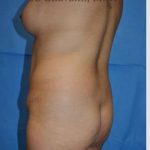 Mommy Makeover Before & After Patient #7396