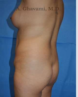 Mommy Makeover Before & After Patient #7396