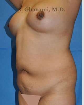 Mommy Makeover Before & After Patient #7396