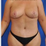 Mommy Makeover Before & After Patient #7387